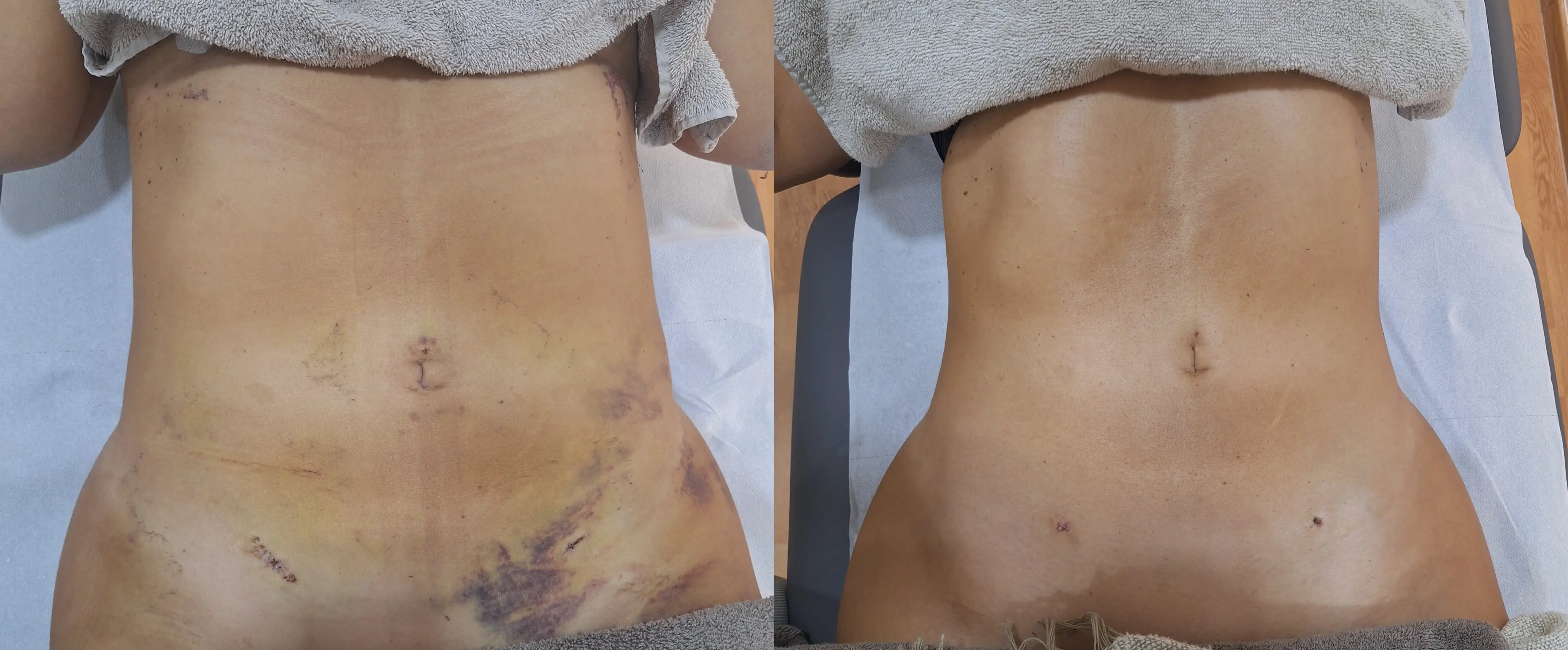 Post Recovery 3